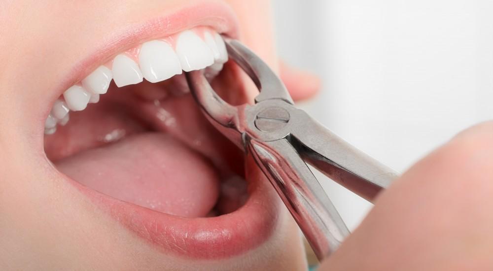 When Tooth Extraction is the Best Solution: Juan M. Carrillo, DMD: General Dentist