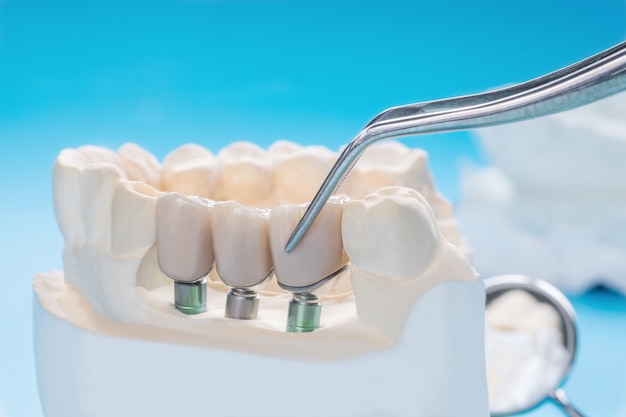 Close up implan model tooth support fix bridge implan and crown. Premium Photo