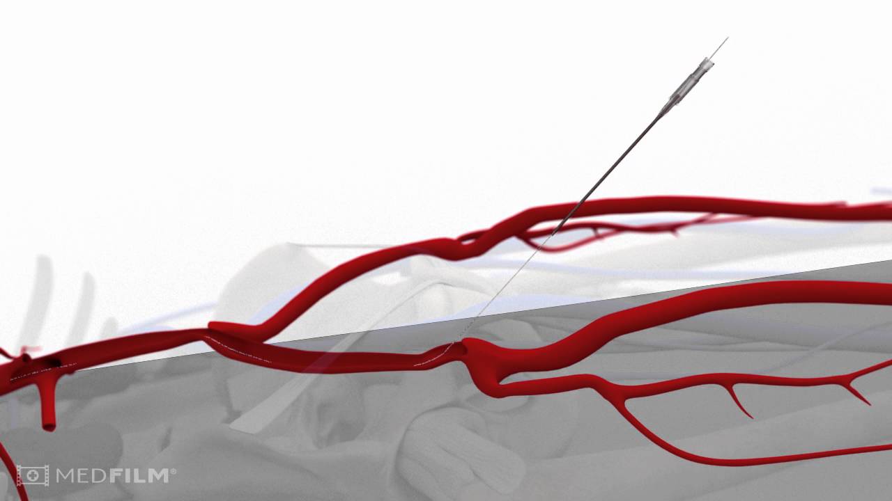 balloon catheter design
