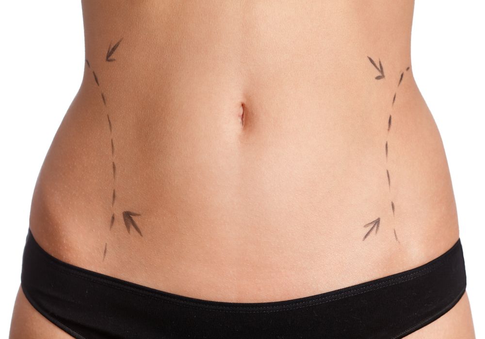 tummy tuck surgery