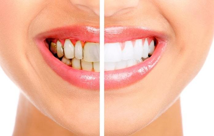Teeth whitening
